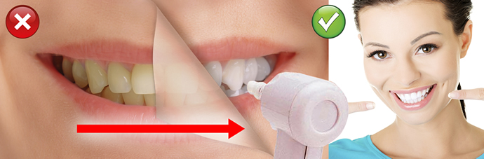 DentalPolisher®, DentalPolisher® voor thuis maakt korte metten met tandsteen en tandplak